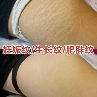 肥胖产后妊纹精油产后祛孕纹预防肥胖纹生长紧致收腹去生长纹