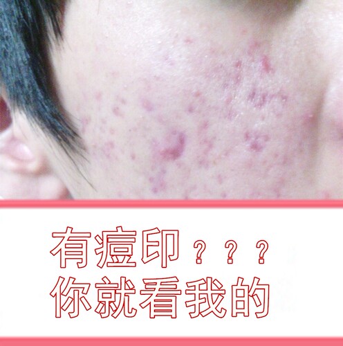 去红黑逗印毛囊痤中炎青春痘脓疮前胸后背脖控油清洁药水螨虫包邮