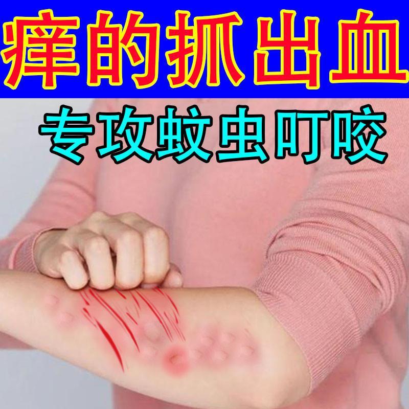 蚊虫叮咬快速止痒消肿婴儿药膏儿童成人专用涂蚊子包止痒抑菌皮肤
