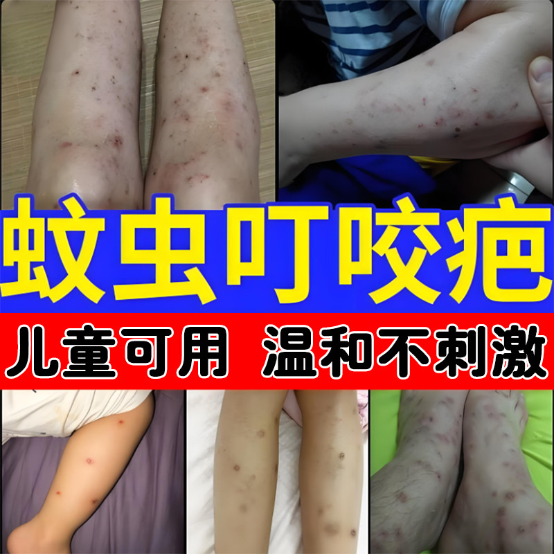 祛儿童腿上蚊虫叮咬疤痕挠印痘印去黑印淡化黑色素沉淀去疤消印药