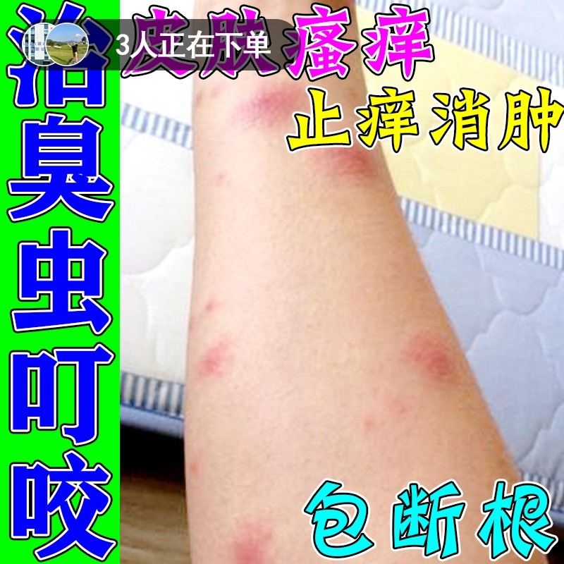 治疗蚊虫叮咬止痒消肿跳蚤螨虫臭虫蚂蚁咬伤止痒专用特效喷雾神器