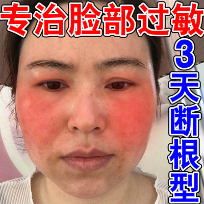 脸过敏红痒修复激素脸特效药膏跟治面部脂溢性皮炎脸起皮干燥碎屑