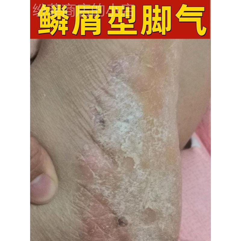 皮肤去角质足癣擦本草泡脚男性真菌儿童中药湿疹治疗草本克星瘙痒
