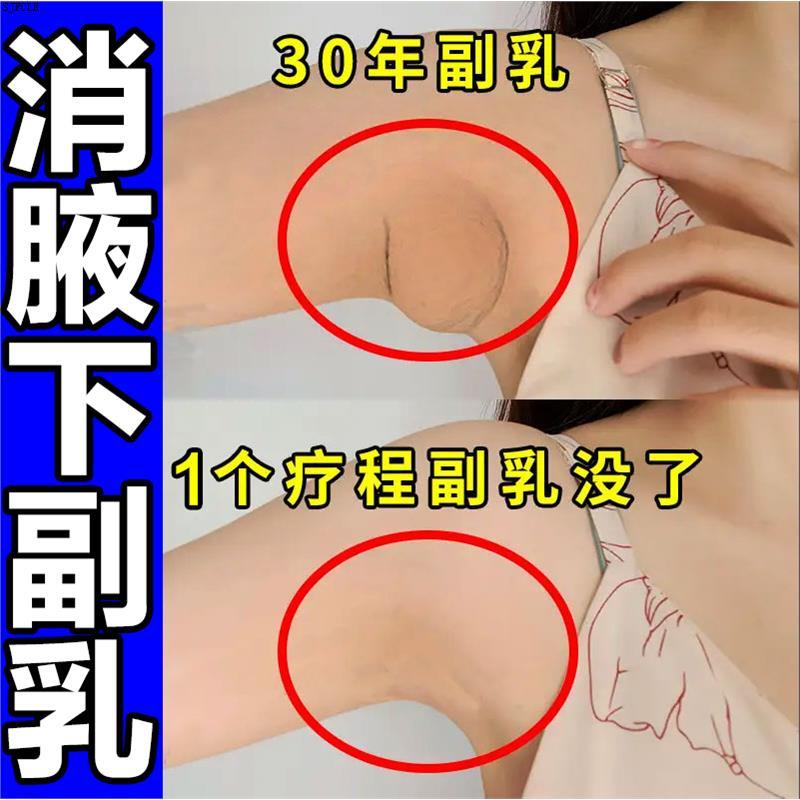 【用过都说好】去副乳神器疏通腋下淋巴肿大散结节消除贴