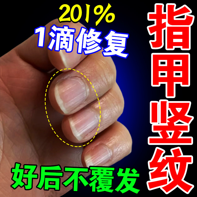 指甲竖纹修复受损开裂甲床分离空甲肉变空指甲增厚发黄生长营养液