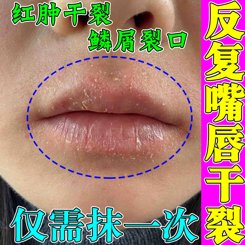 剥落性唇炎口周皮炎脱皮嘴唇汗疱疹唇炎唇膏嘴唇干裂脱皮抑菌软膏