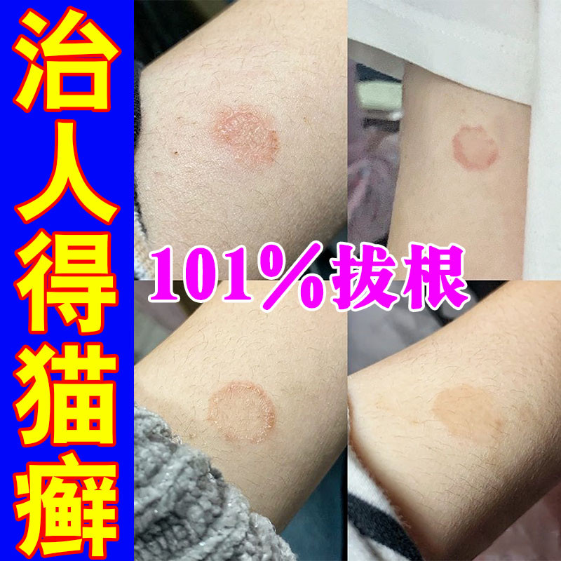 人用猫藓药猫藓外用药得了猫癣专用药皮肤痒人患真菌止痒药膏治疗