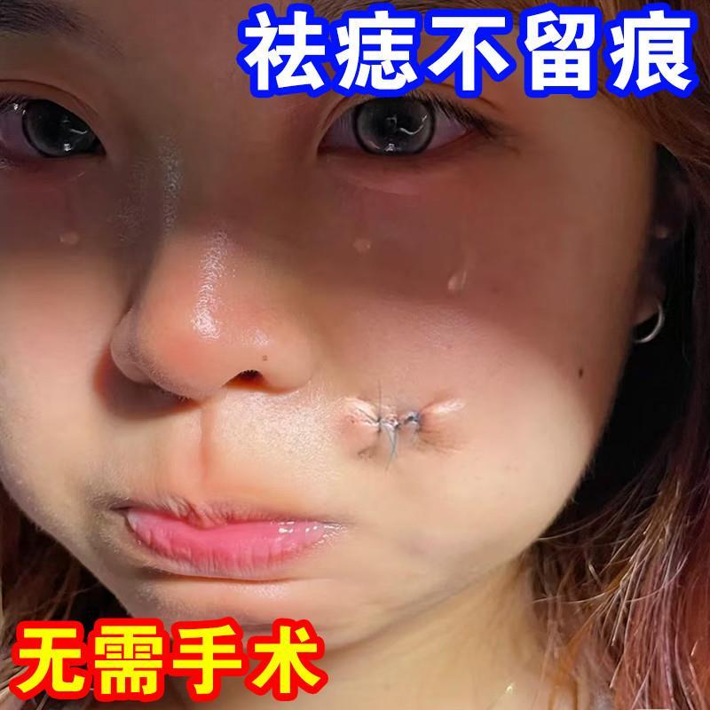 【无忌口 可碰水】哪有黑点抹哪里无痛掉落不留痕祛痣膏全身可