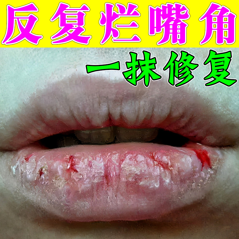 唇炎专用唇膏正品秋冬季嘴唇开裂出血起泡烂嘴唇修复上火嘴唇红肿