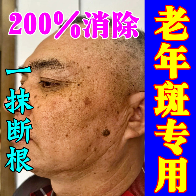 去老年斑的药膏祛去斑专用药水黄褐老年斑强力去除分解黑色素美白