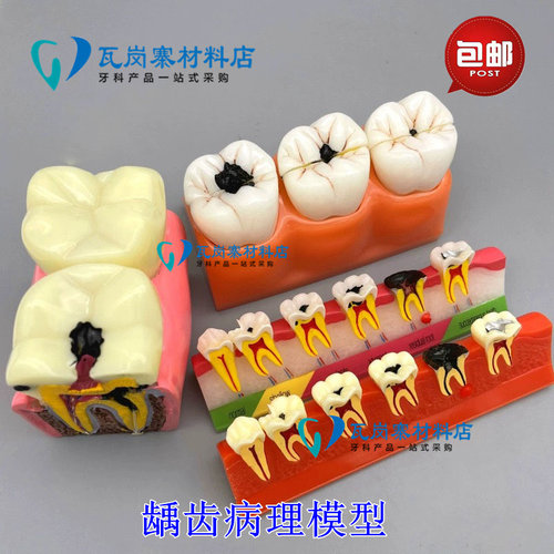 牙科口腔模型6倍龋齿对比 4倍分类 2倍牙齿演变蛀牙分解病理医患