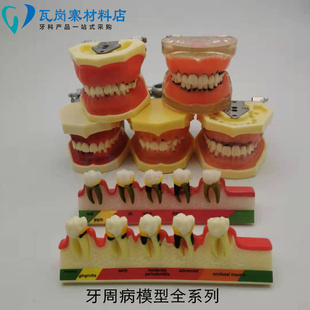 牙周病理模型 练习牙结石刮治模型 刮治器练习软牙龈牙可换  包邮