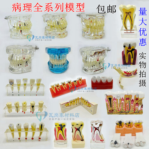 牙科模型蛀牙龋坏发展演示水晶成人病理模型牙齿解剖展示模型包邮