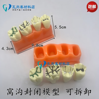 十盈儿童乳牙齿窝沟封闭模型