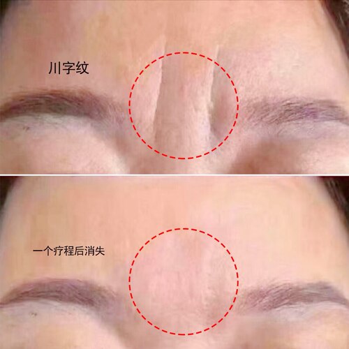 抗皱紧致川字纹眉间贴