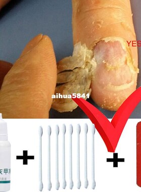 Toe Nail Fungus Treatment Anti Fungal Nail Infection Yellow