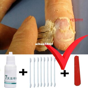 Toe Nail Fungus Treatment Anti Fungal Nail Infection Yellow