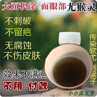 纯植物 传染性软疣水猴子面部瘊子身上治肉刺瘊子大人儿童 去疣灵