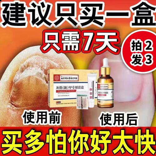 灰指甲抑菌液南京同仁堂买二送一
