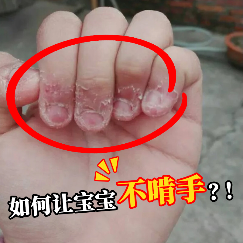 米乐奇防咬手指创可贴护指甲指套