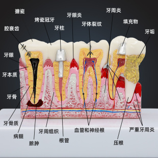 牙科口腔蛀牙龋齿牙病解剖模型牙齿结构模型幼儿园教学刷牙模型