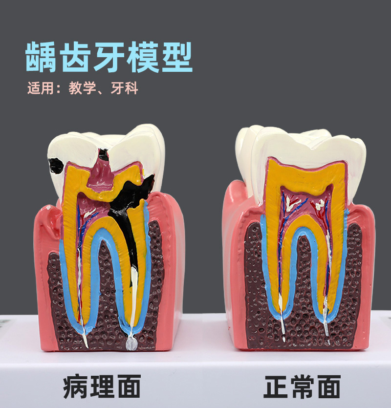 牙科口腔诊所龋齿蛀牙病理牙解剖模型牙齿模型刷牙教学模型幼儿园 玩具/童车/益智/积木/模型 其他模型玩具 原图主图