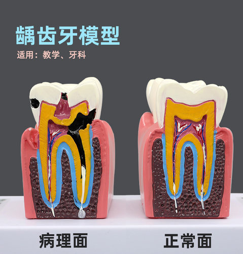 牙科口腔诊所龋齿蛀牙病理牙模型
