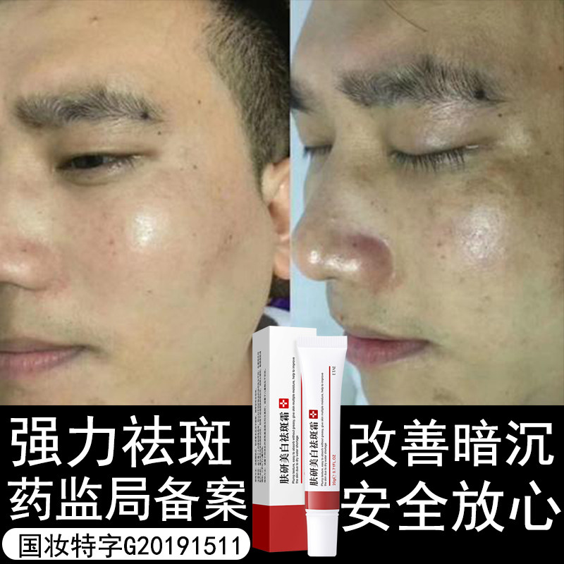 去班黑斑色斑老年斑男士女祛斑霜神器淡化黑色素沉淀脸部去斑霜