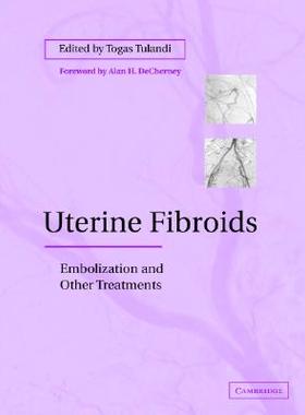 【预售】Uterine Fibroids: Embolization and Other Treatments