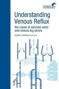 【预售】Understanding Venous Reflux the Cause of Varicose