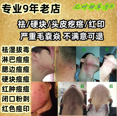 治脸部红肿痘痘头皮毛囊有炎头部头皮痘痘印青春痘专用膏
