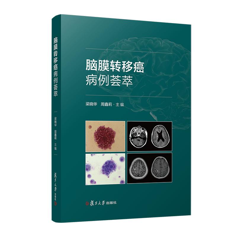 脑膜转移癌病例荟萃 梁晓华 周鑫莉 复旦大学出版社9787309169928