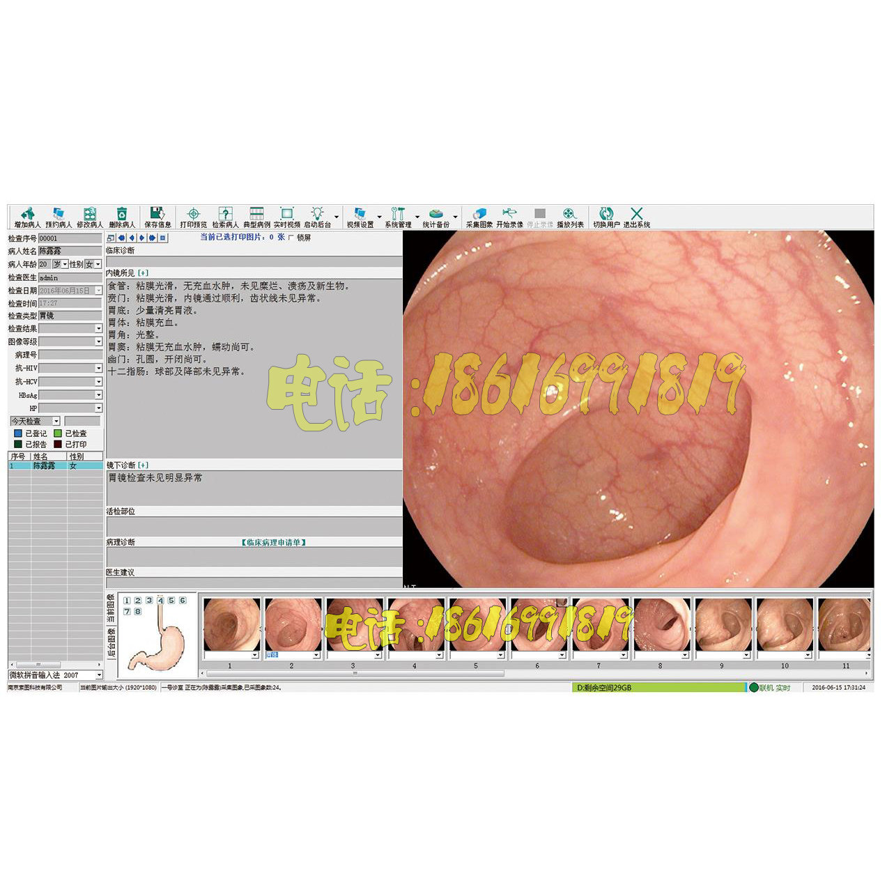高清DVI胃肠镜内窥镜HDMI高清内镜软件高清采集卡连接线脚踏全套