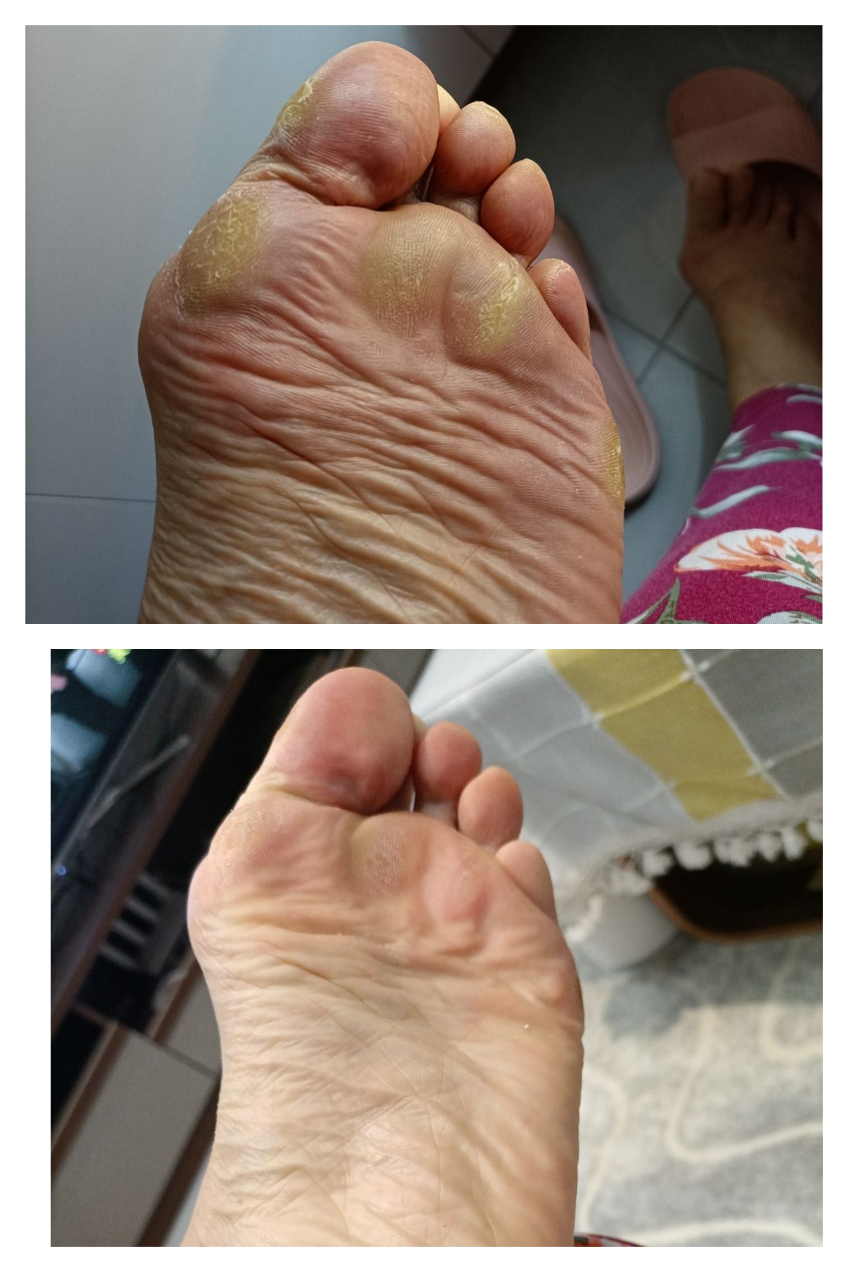 成人足心按摩涌泉穴足弓支撑横弓塌陷扁平足矫正鞋垫拇外翻矫正垫