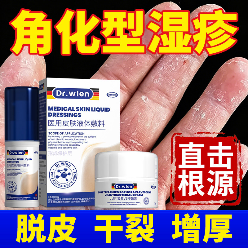 角化型湿疹手癣膏真菌感染专用