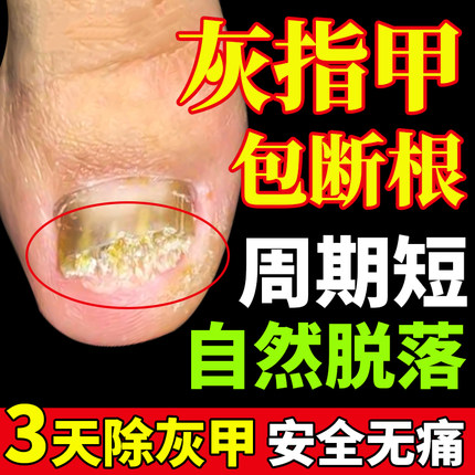 同仁堂灰指甲特效药根治治疗亮甲正品专用药特效药膏甲沟炎旗舰店