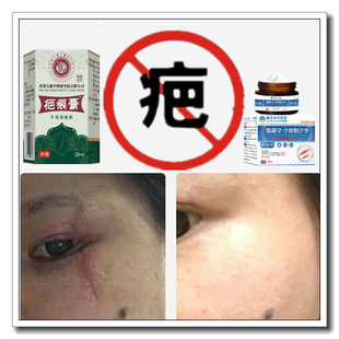 祛凸疙瘩修复药膏增生性体质突起手术剖宫产伤疤痕印灵缝针抓伤液
