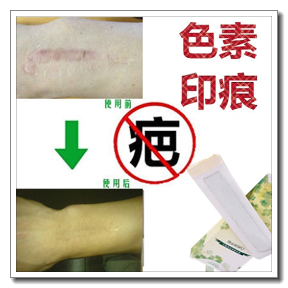 祛双眼皮手术修复膏去除黑色素沉淀全身胸前后背痤疮肤蜡遮盖疤痕
