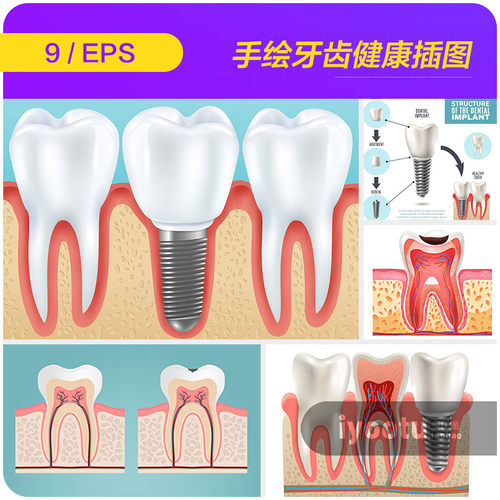 手绘牙齿健康护理种植透视图插图海报eps矢量设计素材模板2232501