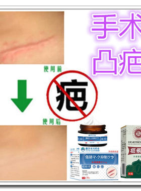 去凸疤疙瘩修复膏增生性突起手术剖腹产伤疤痕印缝针色素沉淀药用