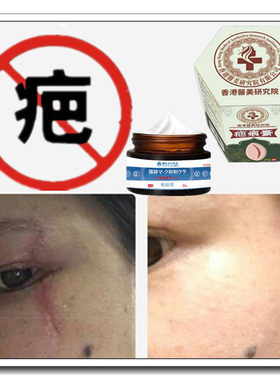 祛色素手术后修复增生性软化凹凸疙瘩去除伤疤痕印灵缝针抓伤药膏