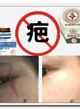 祛增生修复疙瘩性突起缝针剖宫产伤疤痕印激光手术抓伤色素沉着疤