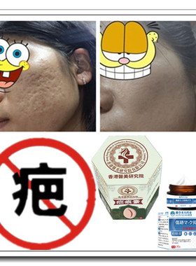 去疙瘩祛儿童增生性凹凸除手术烟烫烧伤药疤痕印激光缝针抓伤摔伤