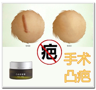 除陈旧点痣增生去凸起祛儿童脸部烫伤疤痕灵正品修复膏美国巴痕贴