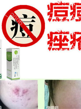 正品植物面疮酒刺印胸前豆豆油性痘痕立消去除青少年痘痘印修复液