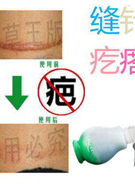 去除儿童冻疮疙瘩修复增生性突起手术剖宫产刀伤巴痕缝针抓伤摔伤
