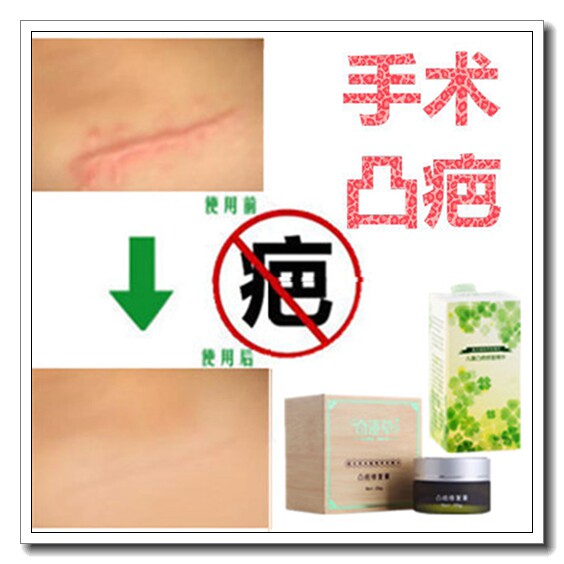 除剖腹产增生凸起软化胸前缝针疙瘩去烫伤刀疤痕体质祛黑疤乐神器