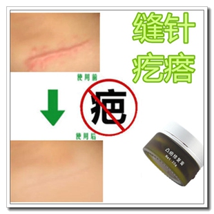 去除摔伤疤痕药膏产品修复舒疤宁硅酮凝胶消祛手术伤口愈合贴正品
