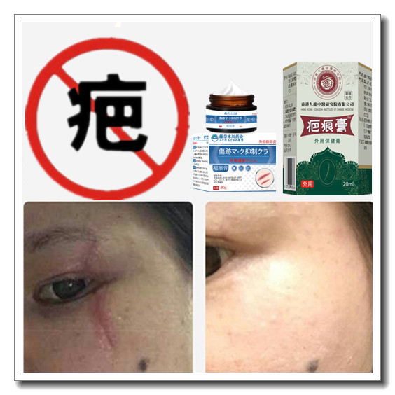 软化烟烫消祛增生性凹凸疙瘩除去手术缝针产后色素伤疤痕印灵斑印