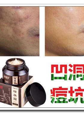 去脸上的痘疤痘印修复丰脸部凹陷填充精油马油祛抓伤凹坑疤痕灵膏